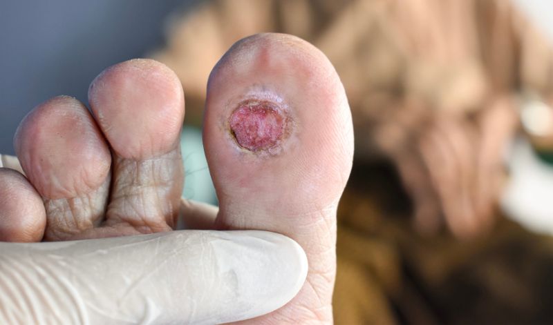 80% aller Menschen mit Diabetes haben krankhafte Hautveränderungen. Typisch ist der sogenannte 'Diabetes-Fuß' 80% aller Menschen mit Diabetes haben krankhafte Hautveränderungen. Typisch ist der sogenannte 'Diabetes-Fuß'
